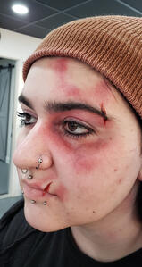 Injuries &amp; Bruises